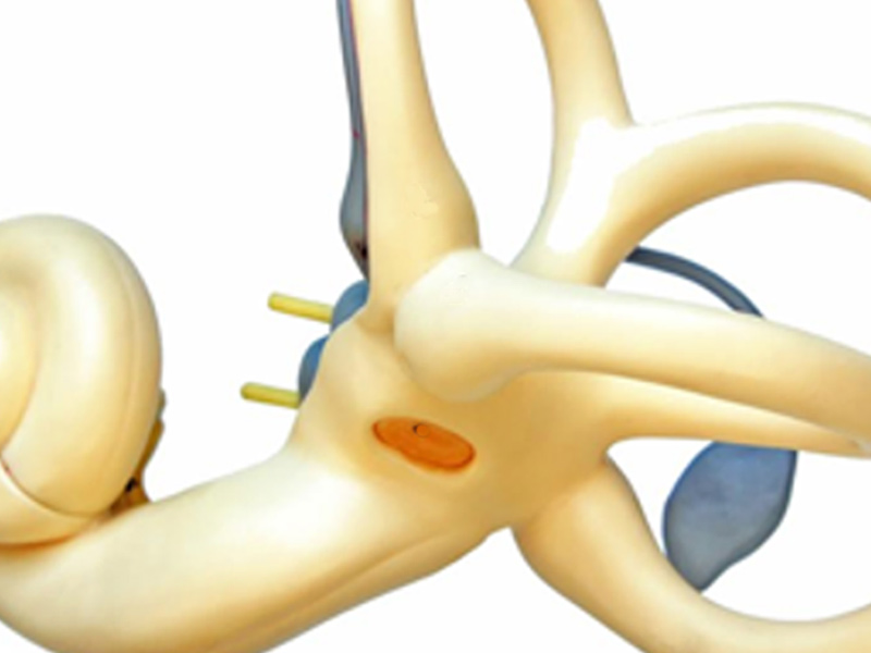 IAE Teste de Fistula Perilinfatica